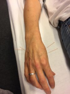 behandling af rygsmerter med kinesisk akupunktur
